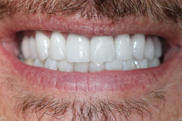 After Veneers